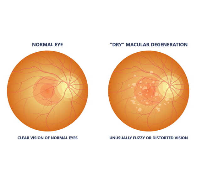 Side‑by‑side fundus images showing a healthy retina and one with macular degeneration